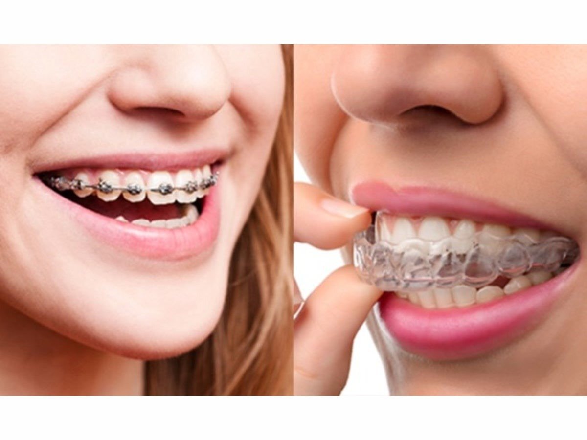Braces & Aligners